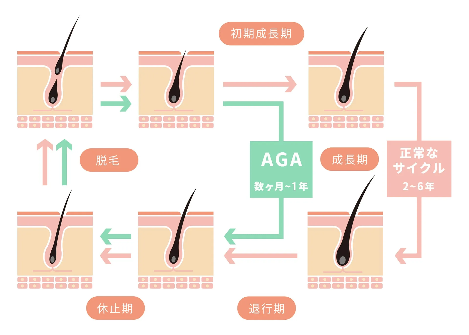 AGA発症メカニズム図解
